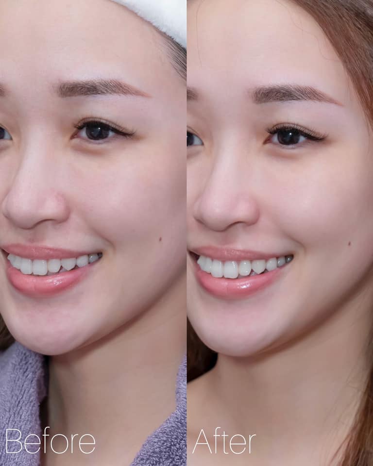 連粉刺都明顯變少了